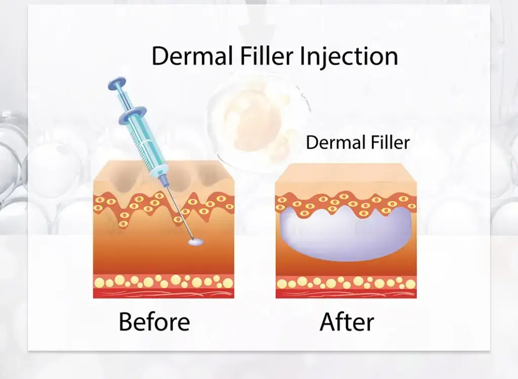 Hyaluronic Acid Dermal Filler