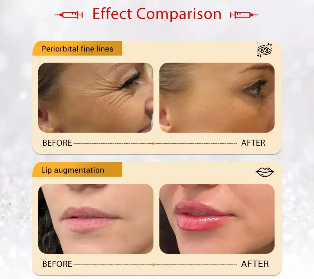 Hyaluronic Acid Dermal Filler