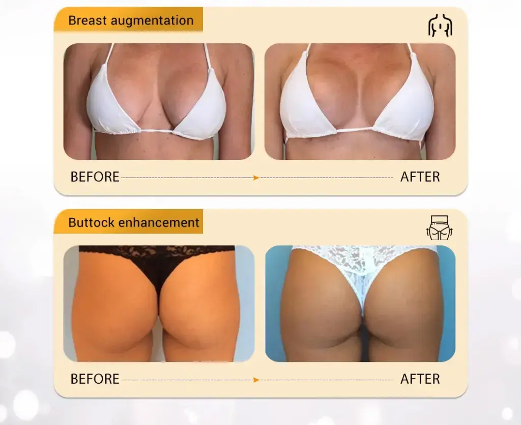 Hyaluronic Acid Dermal Filler